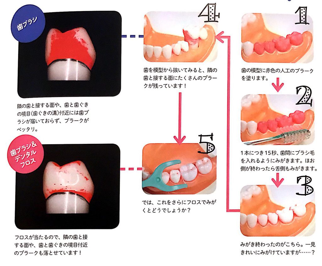 歯 間 ブラシ と フロス の 違い